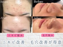 ブランリス 京都店(Blanclis)の雰囲気（REVI認定講師の施術だからの効果！毛穴の皮脂黒ずみ汚れ開きに◎）