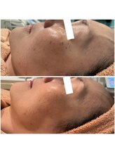 リッツ 草加店(Ritz)/【Before/After】シミ改善