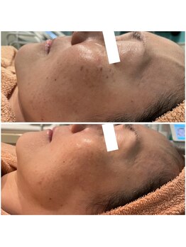 リッツ 草加店(Ritz)/【Before/After】シミ改善