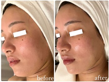 リリィブラン(Lily branc)/小顔フェイシャル/マシン2種