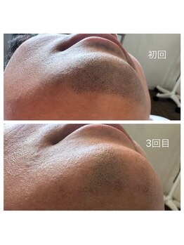 プライベートサロン アール(R)/あごの脱毛☆