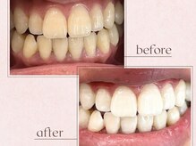 ルアナシンフォニア エクシア 恵比寿店(Luana-Sinfonia)/ホワイトニングビフォーアフター