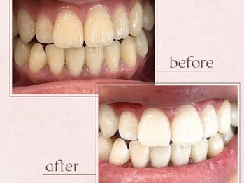 ルアナシンフォニア エクシア 恵比寿店(Luana-Sinfonia)/ホワイトニングビフォーアフター