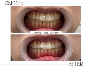ホワイトニングサロンブライト 尼崎店(Whitening salon bright)/ご新規様のbefore/after