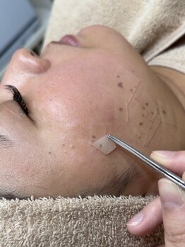 ブレデサガ(B’lady Saga)の写真/【諦めていたシミを徹底改善】話題のシミケア≪ホワイトラボ≫導入サロン！1箇所～ケアし放題まで◎