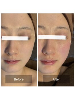 ラビ(RABBI)/20代女性レモンボトル小顔