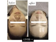 ミミ(mimi)/お肌が安定しトラブル知らずに！