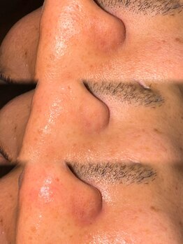 アクシア ビューティー サロン(AXSIA)/【ハイドラフェイシャル】