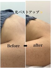 メディカルサロンドオフ 堺東店(medical salon de off)/光バストアップメニュー♪前後