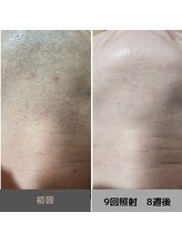 キムラケ 和光別邸(木村家 KIMURAKE)/メンズ脱毛ヒゲビフォーアフター