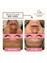 キュオバイアンドリープ(Qo by &LEAP)/光フェイシャル/beforeafter
