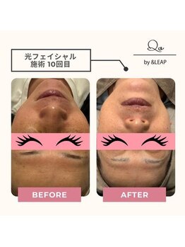 キュオバイアンドリープ(Qo by &LEAP)/光フェイシャル/beforeafter