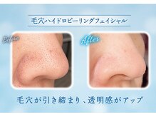 ニナル(...ninaru)/☆毛穴特化ハイドロピーリング☆