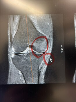 ライズ/お膝への施術