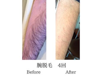 メンズミーシェ(Men's Meshie)/うで脱毛の4回施術後