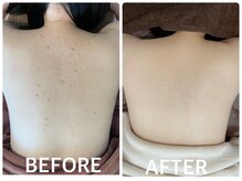 ハーブピーリング 心斎橋/背中ニキビ改善