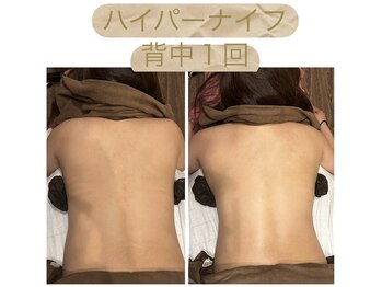 ビボーン ボディ(美bone body)/ハイパーナイフ背中１回で♪