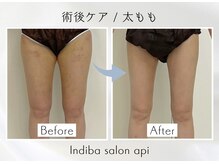 アピ(api)/症例写真【インディバ】