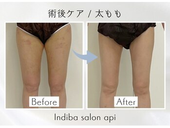 アピ(api)/症例写真【インディバ】