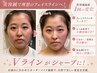 【小顔/左右差/二重顎/たるみ改善】究極小顔★美容鍼60分¥5980