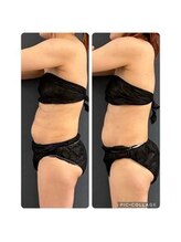 インディバサロン(INDIBA SALON 8296)/産後なかなか痩せない。