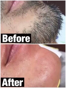 バブル(BUBRU)/メンズ脱毛