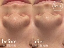 フェイン 青山店(fein.)/剥離なしハーブピーリング★