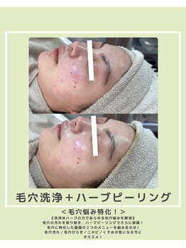 ソワナ(soina)/【神楽坂駅/フェイシャル/毛穴】