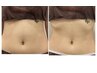 【韓国発レモンボトル】お腹7cc 脂肪分解＋酸素カプセルで効果アップ