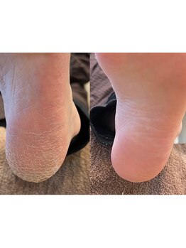 角質ケアができるサロン