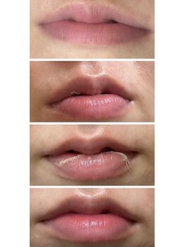 キュライム カブール町田店/1回でピンクになれる