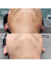 エイプリルプラス(April plus)/ヒゲ脱毛