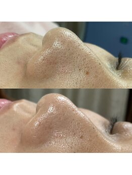 シンディー(CINDY)/毛穴洗浄