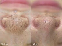 ミュー 春日井店(mieux)/◆肌質改善例