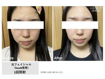 ルル 西八王子店(LuLu)の写真/重ね打ち♪THR光フェイシャル