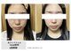ルル 西八王子店(LuLu)の写真/重ね打ち♪THR光フェイシャル