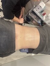 ビジリンヌ/ラジオ波フェイシャル