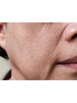 シミしわ改善！予防ケア