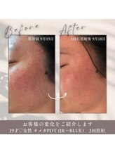 エクラ アン(eclat.un)/オメガPDT　女性