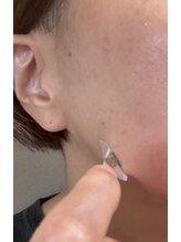 アレイズ(ARAYS)/症例(スポット)