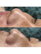 シンディー(CINDY)/毛穴洗浄