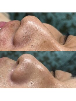 シンディー(CINDY)/毛穴洗浄