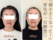 スウ(suu.)/Before-After【40代】2回目