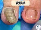 変形・肥厚した爪を正常な爪へ