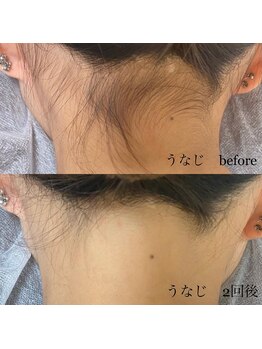 ナブラ デュオ(NABLA Duo)/レディース脱毛