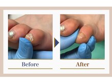 巻き爪補正店 錦糸町店/【副爪ケア】