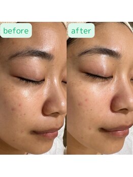 エトワール 駒沢大学駅前店(ETOILE)/肌質改善|毛穴・美白ケア