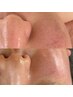 【毛穴開き、たるみ毛穴】肌悩みに　臍帯由来幹細　今だけ17,500 → 【所沢】