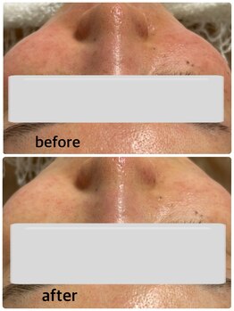 サロン カレア(Salon Kalea)/ハーブピーリング