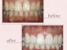 ルアナシンフォニア エクシア 恵比寿店(Luana-Sinfonia)/ホワイトニングビフォーアフター